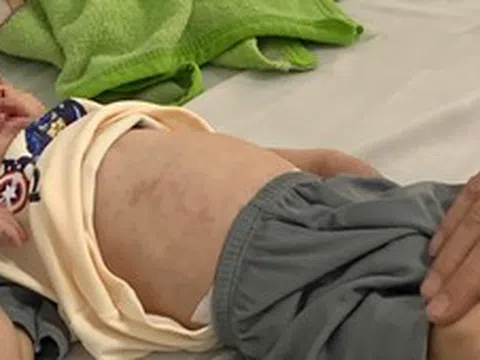 Số ca sốt xuất huyết và tay chân miệng tăng nhiều lần