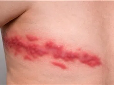 Cảnh báo nguy cơ gia tăng bệnh zona ở người có bệnh mạn tính