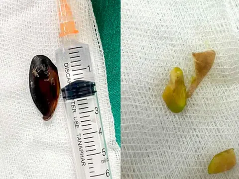 Bé 14 tuổi ho khan kéo dài, gia đình sốc khi bác sĩ lấy ra dị vật bên trong cơ thể