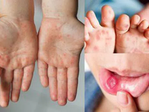 Cảnh báo bệnh tay chân miệng và sốt xuất huyết tiếp tục gia tăng, nhiều ca nặng