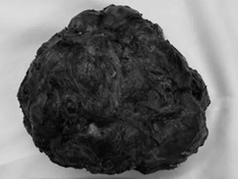 Cô gái trẻ 26 tuổi vòng một to bất thường, bác sĩ phát hiện bí mật bên trong