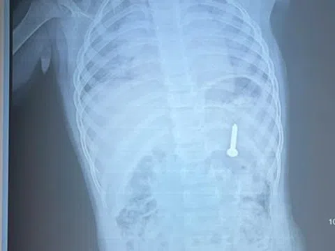 Đang chơi ở nhà, bé gần 2 tuổi nuốt phải thứ "đáng sợ"