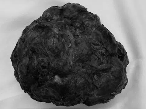 Cô gái trẻ 26 tuổi vòng một to bất thường, bác sĩ phát hiện bí mật bên trong