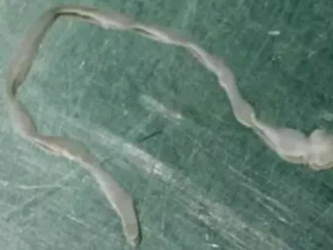 Người phụ nữ lên cơn co giật, bác sĩ lấy ra thứ đáng sợ trong não