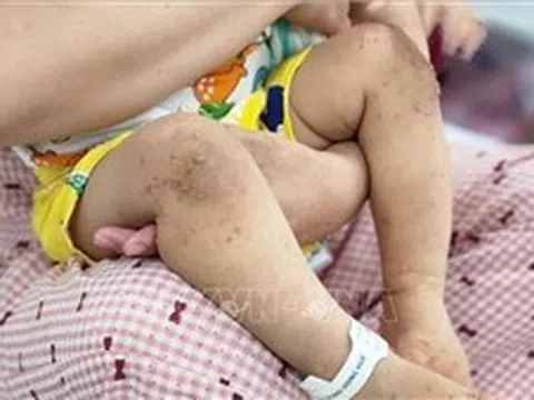 Số trẻ mắc bệnh tay chân miệng tăng gấp 3,5 lần so với cùng kỳ năm trước