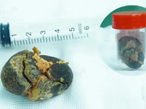 Đi khám sức khỏe định kỳ, người phụ nữ "sốc" khi phát hiện điều bất ngờ