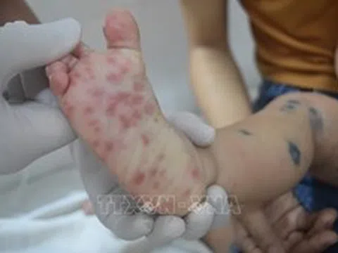 Tăng cường công tác truyền thông, kiểm soát bệnh tay chân miệng