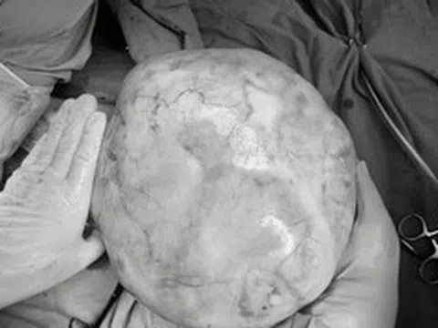 Bé gái 14 tuổi bụng to bất thường, bố mẹ sốc khi phát hiện bí mật "đáng sợ" bên trong