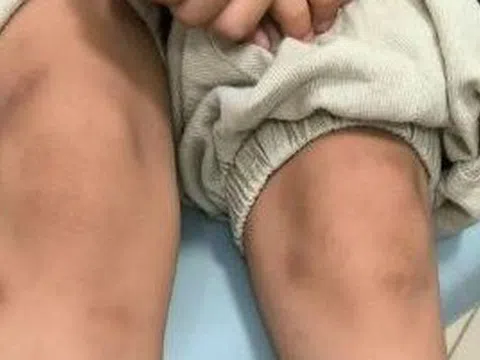 Ăn thịt nướng cuốn xà lách, bé trai 6 tuổi nổi đầy vết bầm tím "bất thường"