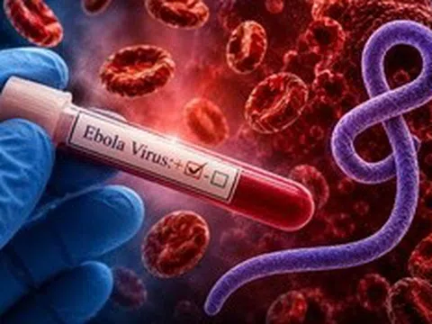 Bác sĩ cảnh báo triệu chứng của Ebola dễ bị bỏ qua