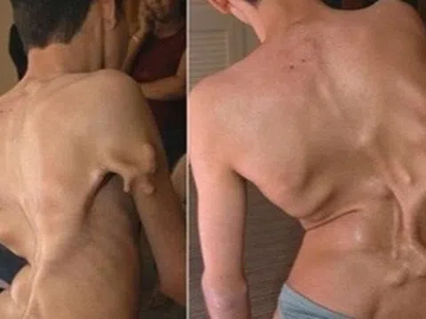 Bé gái 12 tuổi mắc hội chứng "người hóa đá" cực hiếm, cả triệu người mới có một ca