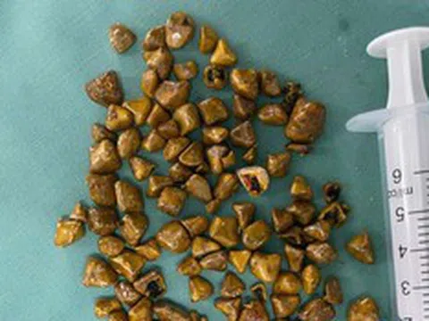 Người phụ nữ 39 tuổi đau bụng không chịu nổi, bác sĩ gắp ra thứ "đáng sợ" bên trong