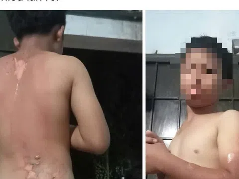 Công an vào cuộc vụ mẹ tạt nước sôi lên người con trai