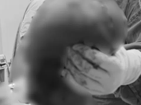 Bé gái 14 tuổi có vùng mông to bất thường, sự thật phía sau khiến gia đình "sốc ngang"