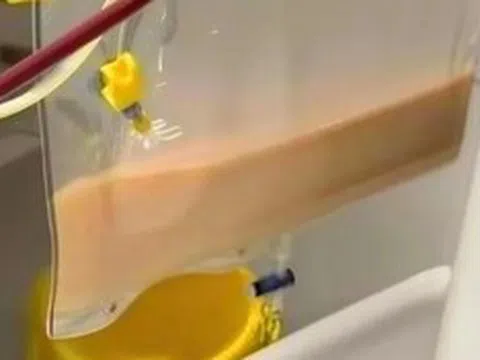 Người đàn ông 40 tuổi có "máu trắng đục như sữa", bác sĩ cảnh báo thói quen "sướng miệng, hại thân"