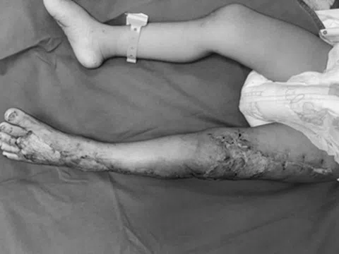 Bị rắn hổ mang cắn nguy kịch, bé 41 tháng tuổi được cứu sống ngoạn mục