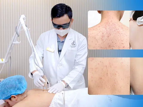 Những lý do Phòng khám Da liễu LG trở thành địa chỉ điều trị viêm nang lông hàng đầu hiện nay